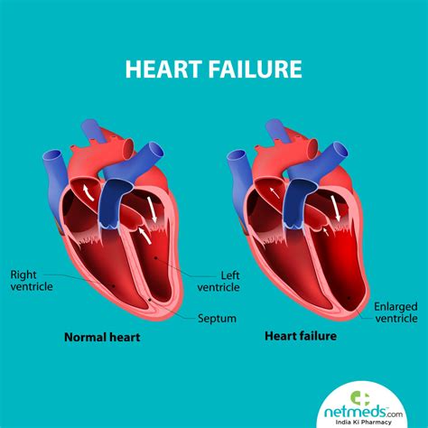 lv systolic dysfunction meaning.